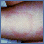 skin with blotch from Lyme disease