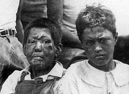 Young boys with Hansen's Disease, ca. 1900.