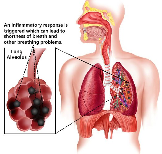 A diagram of a human respiratory system and closeup of a lung alveolus, the small sacs in which air exchange takes place. Dark particles are trapped in the alveolus. Caption: an inflammatory response is triggered which can lead to shortness of breath.