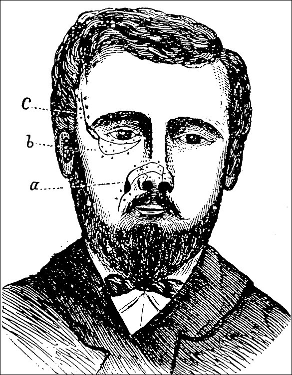 Drawing of a man from the chest up with proposed incision marks.