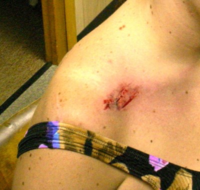 photos showing wild horse bite mark on visitor's shoulder