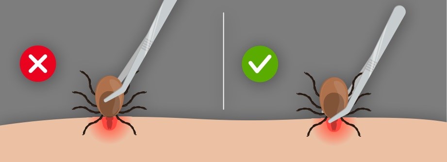 Tick removal illustration