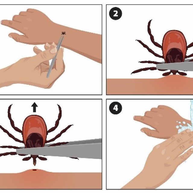 A graphic showing how to use tweezers to grip and then remove a tick from the skin