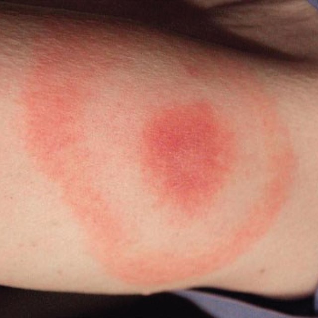 A person's elbow with a round red circle surrounded by a red ring showing a strong bite reaction
