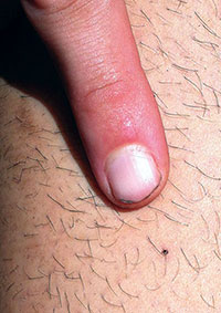 A tick nymph embedded in the skin of a hiker (Credit: Karl Ford) A tick nymph embedded in the skin of a hiker (Credit: Karl Ford)