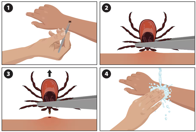Graphic with four images showing how to remove a tick if found embedded on the skin.  1-Grasp tick with tweezers or tick remover. 2- Closeup of tick head in tweezers. 3 - Pull tick away from skin, not at an angle. 4 - wash area with soap and water