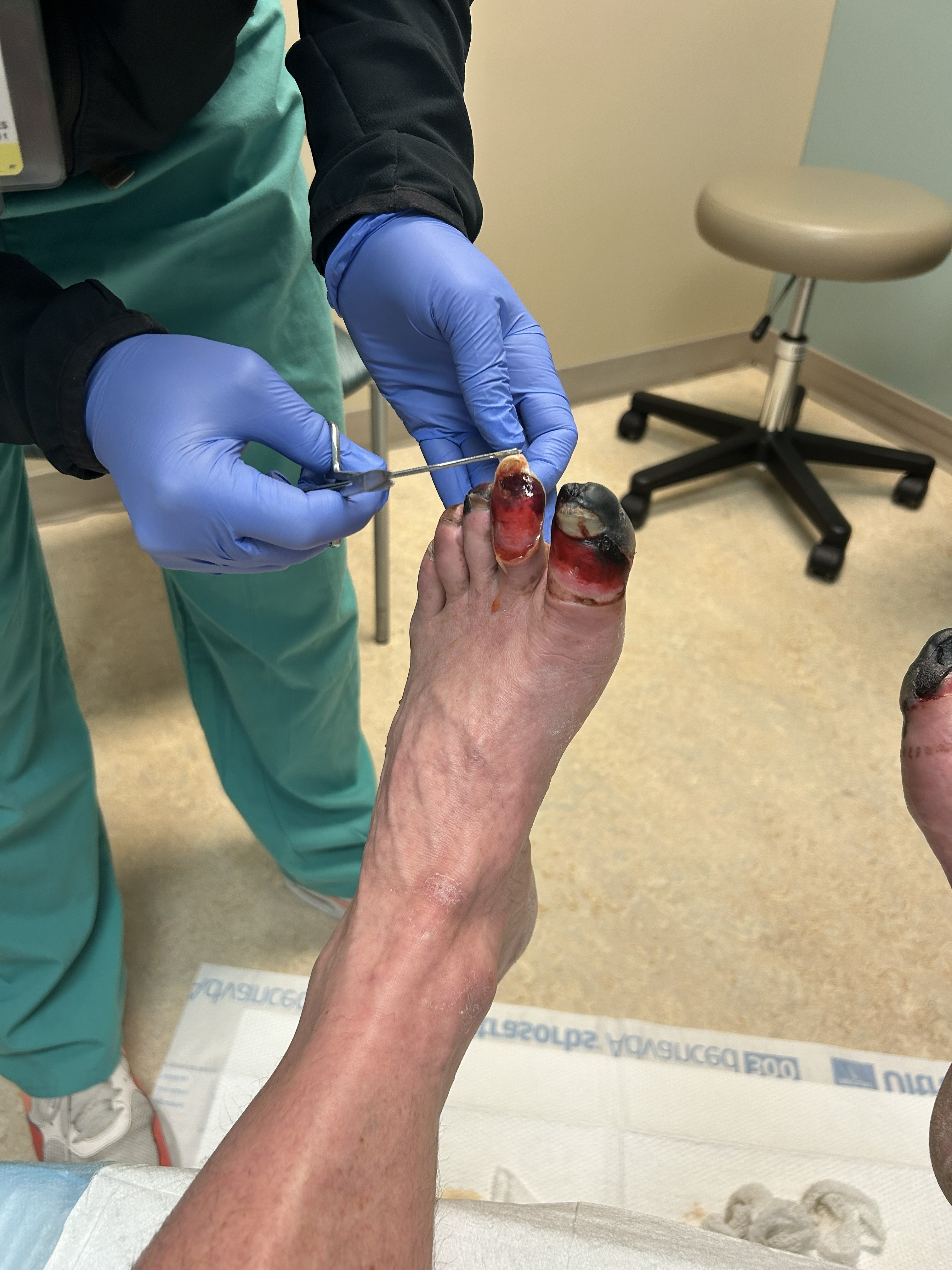 Debridement of dead tissue a few weeks after the injury. Photo: G. Huey