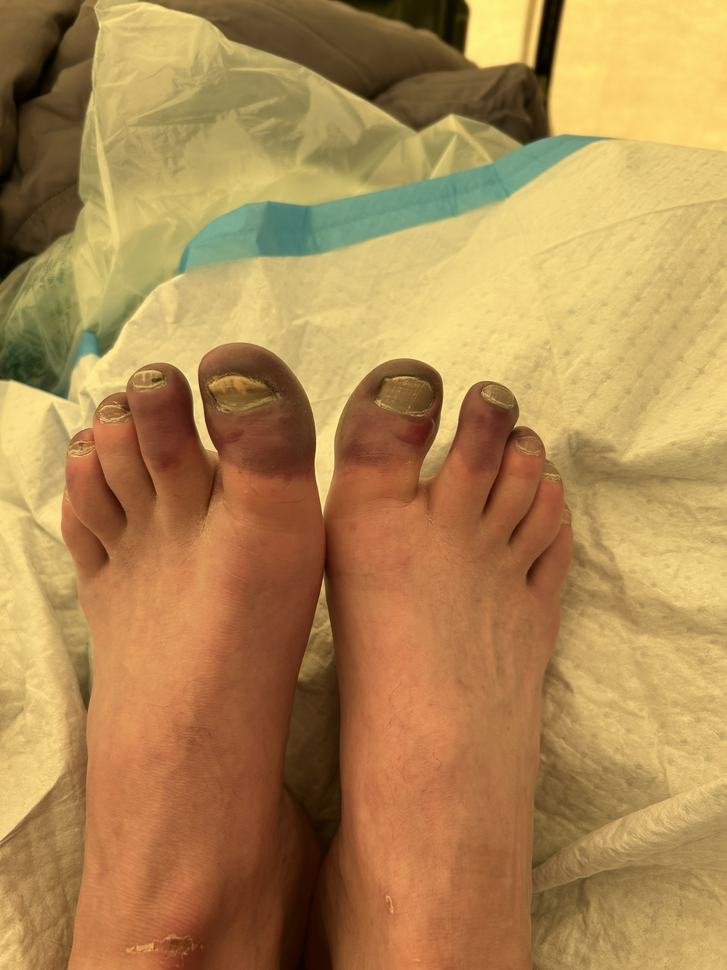 The demarcation between healthy and injured tissue clearly visible after a warm water bath. Photo: G. Huey