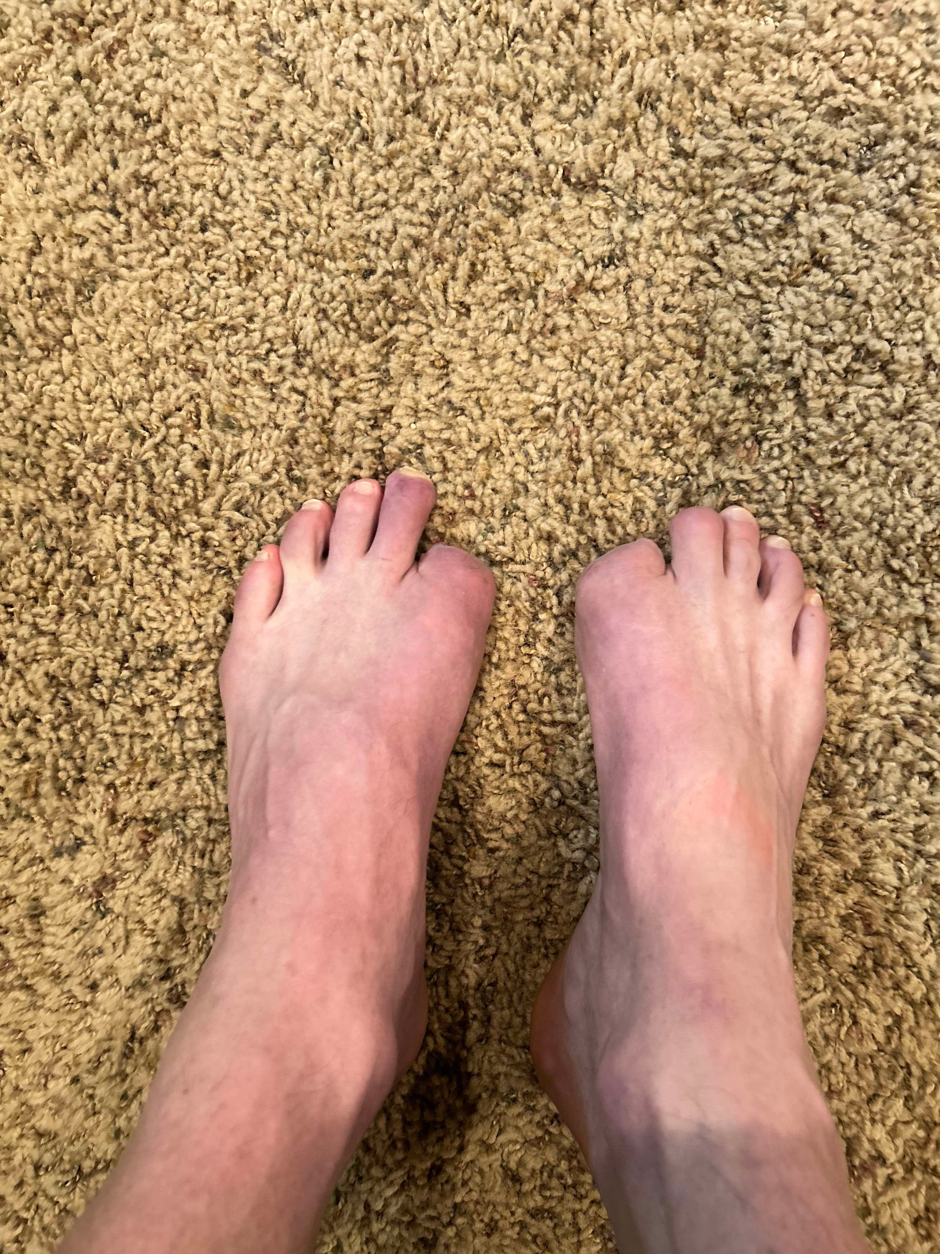 Greg’s feet after surgical intervention in July 2025. Photo: G. Huey