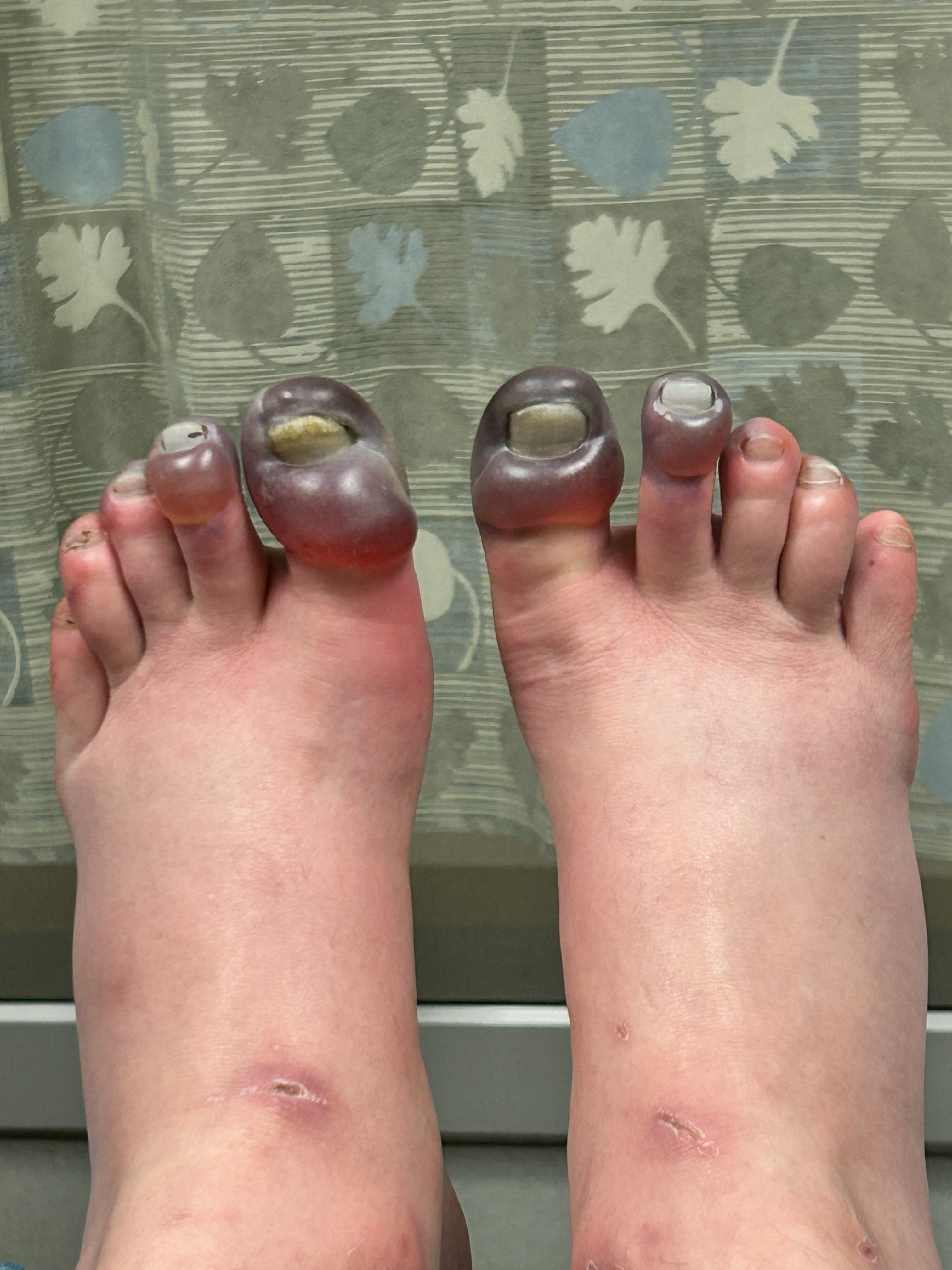 Greg’s feet in the hospital post-evacuation, about 5 days after injury. Photo: G. Huey