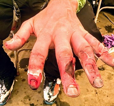 Close-up of a hand with frostbite damage, including redness and torn skin