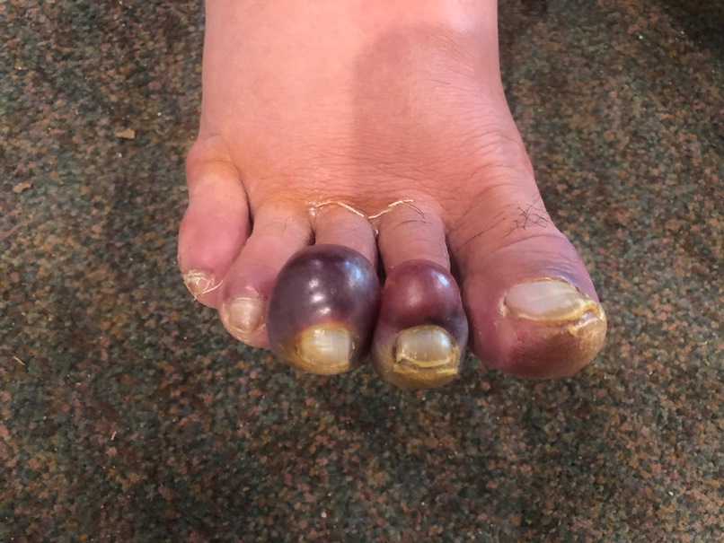 A foot with red and purple swollen toes