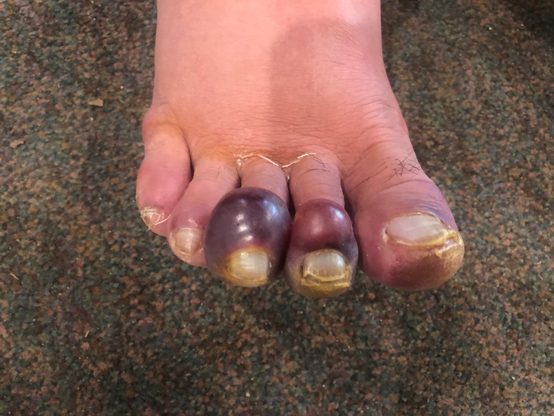 Ugly toes A foot with red and purple swollen toes