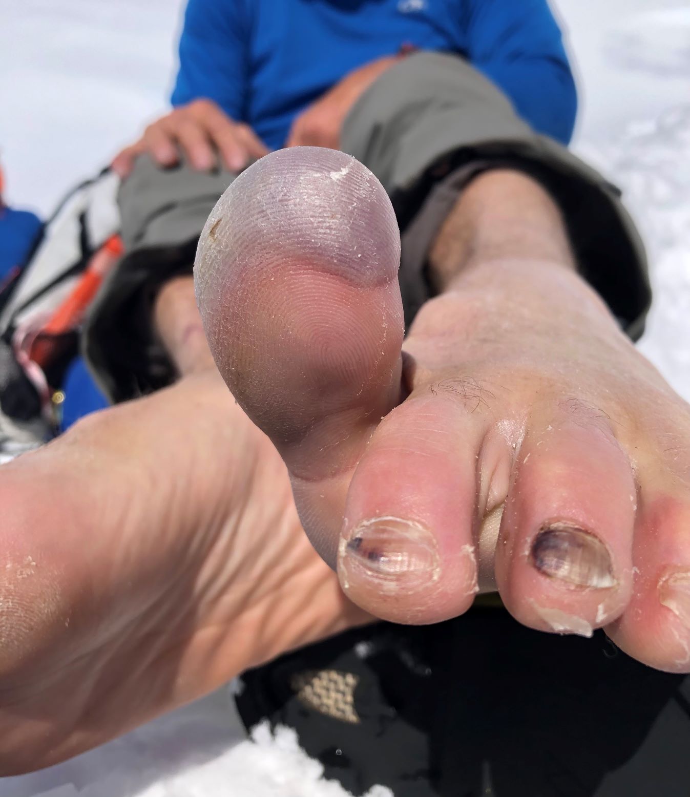 A climber exposes his frostbitten, swollen big toe