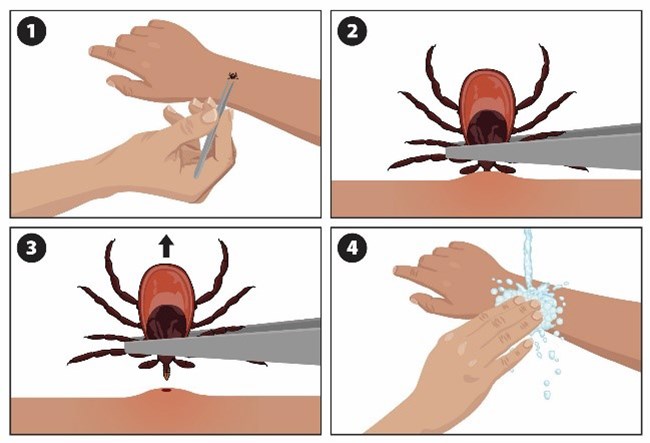 A graphic showing the four steps to safely remove a tick with tweezers