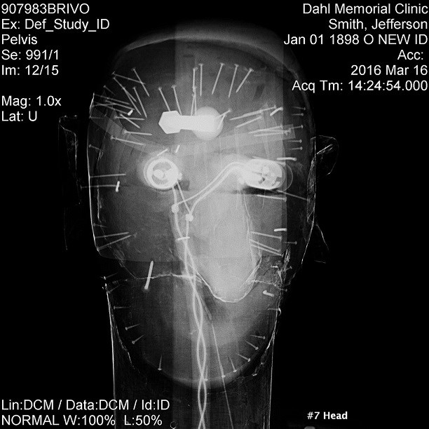 A X-ray of Soapy Smith's manikin face.