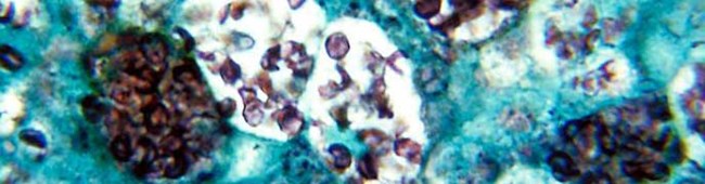 Histoplasmosis capsulatum Histoplasmosis capsulatum