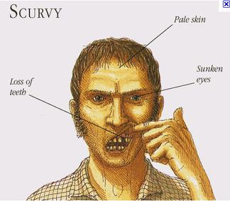 Color sketch of sailor showing symptoms of Scurvy Color sketch of sailor showing symptoms of Scurvy
