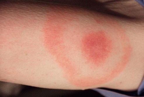 cdc_photo_of_lyme_disease_bullseye_rash