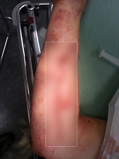 Victim's arm after receiving 27 stitches Victim's arm after receiving 27 stitches