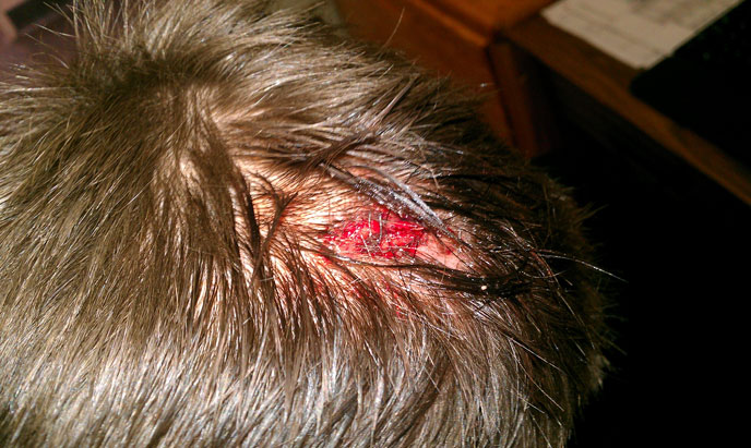 Head laceration